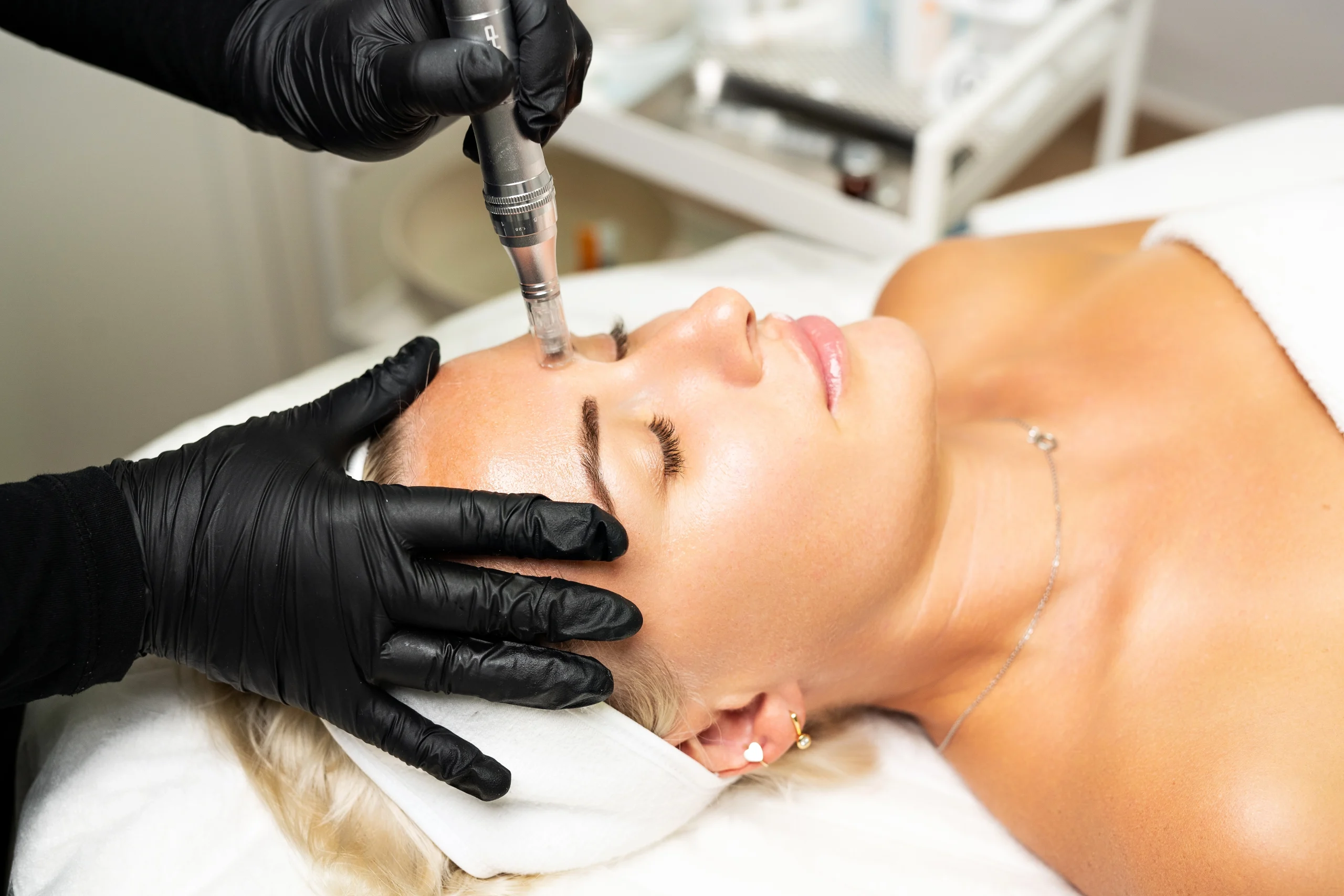 Does Microneedling Really Improve Acne Scars? What You Need to Know? banner